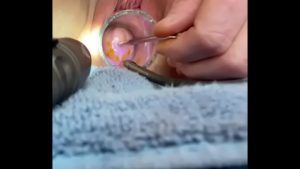 Tiến triển âm thanh 6mm ở cổ tử cung kèm theo chuột rung